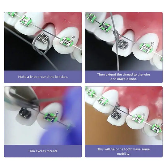 Step-by-step demonstration of using Dental Ortho Elastic Thread Traction Ligature Power Tube for orthodontic treatment, showing bracket attachment, thread extension, trimming, and resulting tooth mobility