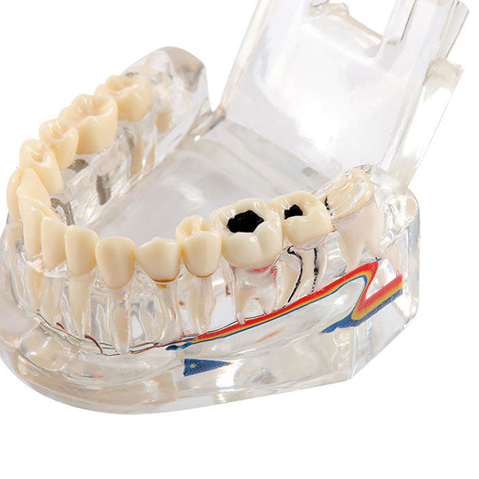 Dental Oral Typodont Model Implant Pathological Removable Teach Demo Transparent