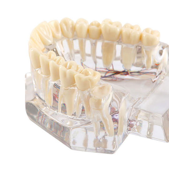 Dental Oral Typodont Model Implant Pathological Removable Teach Demo Transparent