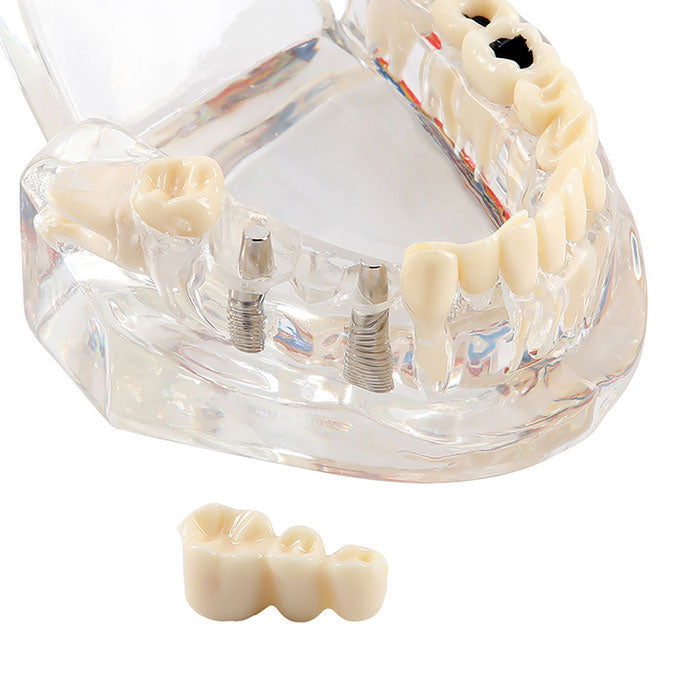 Dental Oral Typodont Model Implant Pathological Removable Teach Demo Transparent