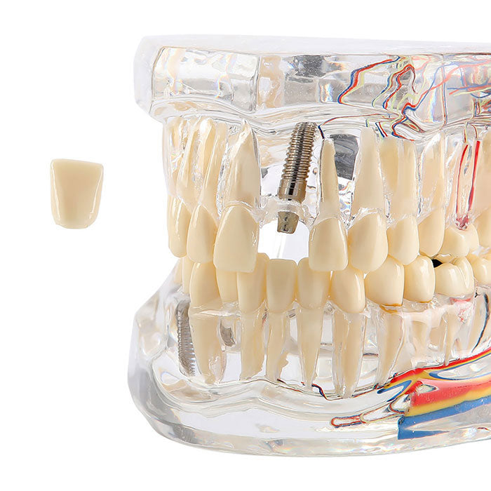 Dental Oral Typodont Model Implant Pathological Removable Teach Demo Transparent