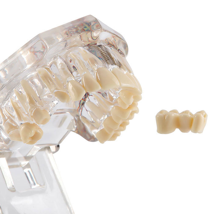 Dental Oral Typodont Model Implant Pathological Removable Teach Demo Transparent