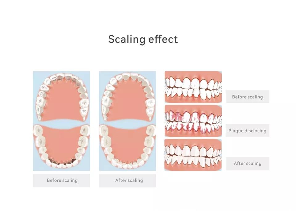 Woodpecker Dental PT-A Ultrasonic Scaler & Air Polisher 2 in 1 Smart System