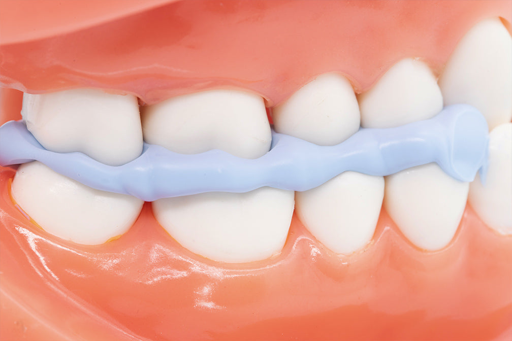 Close-up view of dental bite registration material in blue applied between upper and lower teeth demonstrating accurate occlusal registration with PERFIT Bite Registration material