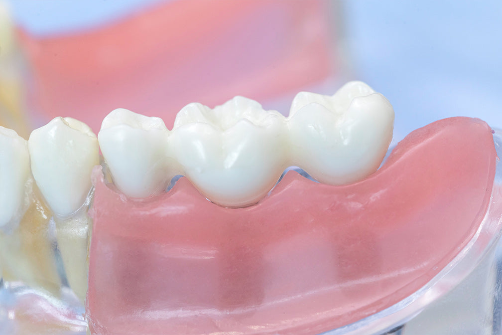 Dental model showing Glass Ionomer Cement Luting I application on lower prosthetic teeth demonstrating precise bonding and natural-looking finish for crown and bridge work