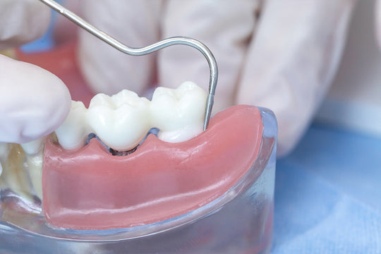 Dental model demonstrating application of Glass Ionomer Cement Luting II on prosthetic teeth with metal dental tool, showcasing cementation technique for ceramic crown restoration