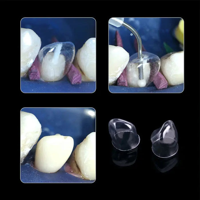 Dental Anterior Transparent Crowns for Adult № 1.910 64Pcs/Box: Four-panel image showing dental crown application process, including transparent crowns, dental tools, and fitted crowns on teeth models, demonstrating product usage and appearance.