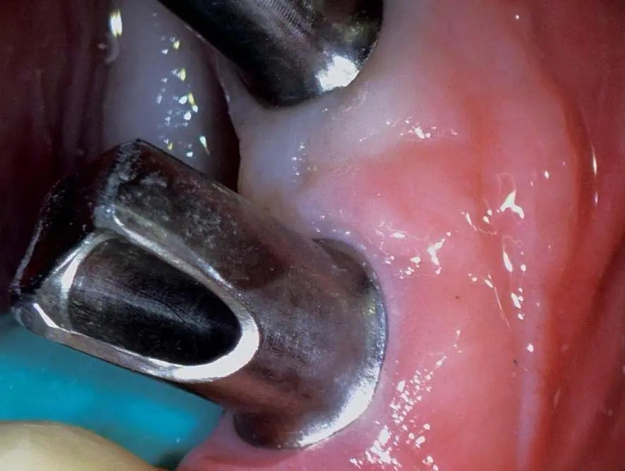 CamX Triton HD intraoral camera capturing high-definition close-up image of dental procedure, showing dental instrument in contact with gum tissue and tooth surface, demonstrating the camera's precision and clarity for detailed oral examinations and patient education.