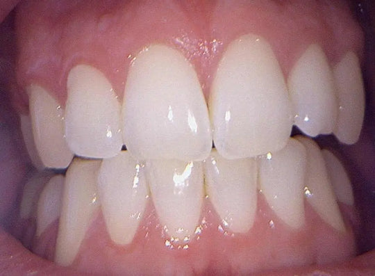 Close-up view of healthy teeth captured by CamX Triton HD, showcasing clear, high-definition dental imaging with natural white color and pink gums, demonstrating the camera's ability to provide detailed intraoral images for patient education and diagnosis.