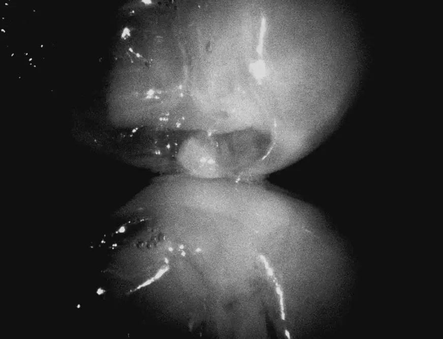 High-definition intraoral image captured by CamX Triton HD, showing detailed view of teeth and gums in black and white. The image highlights the camera's ability to capture clear, close-up dental structures for diagnostic purposes and patient education.