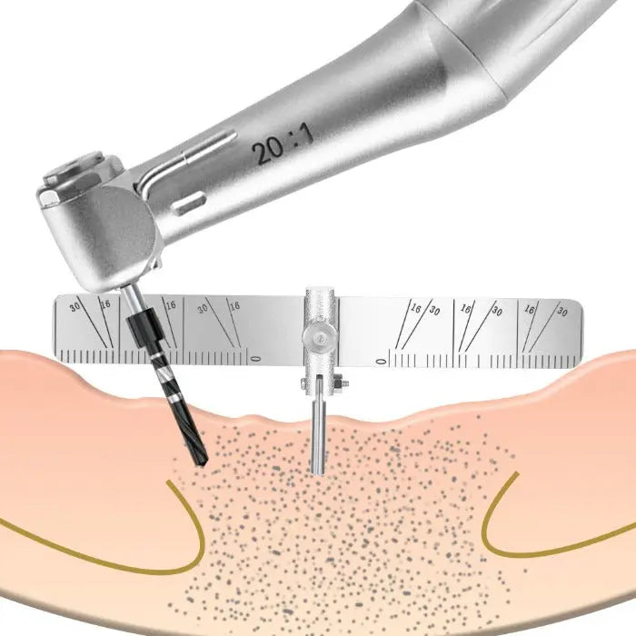 Dental Implant Locating Guide Planting Positioning Locator Angle Ruler Guage Autoclavable shown in use, with a stainless steel ruler positioned over a diagram of gum tissue and implant placement. The device aids in precise measurement and positioning during dental implant procedures.