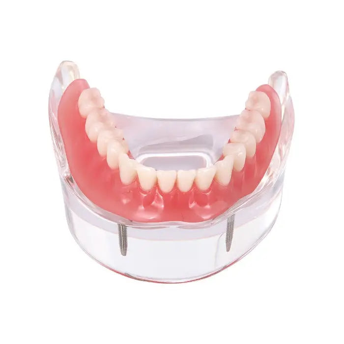 Dental Implant Teeth Model Demo Overdenture Restoration With 2 Implants Lower, showing clear acrylic lower jaw with pink gums, white teeth, and visible implant attachments. Transparent base reveals internal structure for educational demonstration of overdenture functionality.