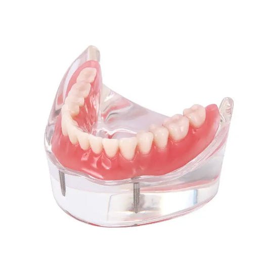 Dental Implant Teeth Model Demo Overdenture Restoration With 2 Implants Lower: Clear acrylic lower jaw model showing pink gums, white teeth, and visible implants for demonstrating overdenture function and dental procedures