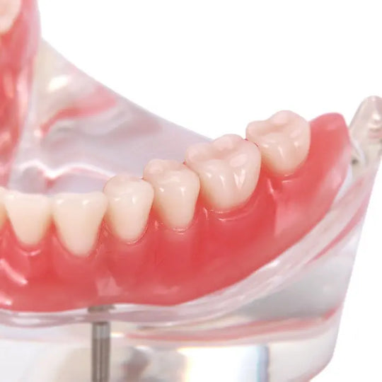 Dental Implant Teeth Model Demo Overdenture Restoration With 2 Implants Lower showcasing clear acrylic lower jaw with realistic teeth and gums, demonstrating implant-supported overdenture for educational purposes