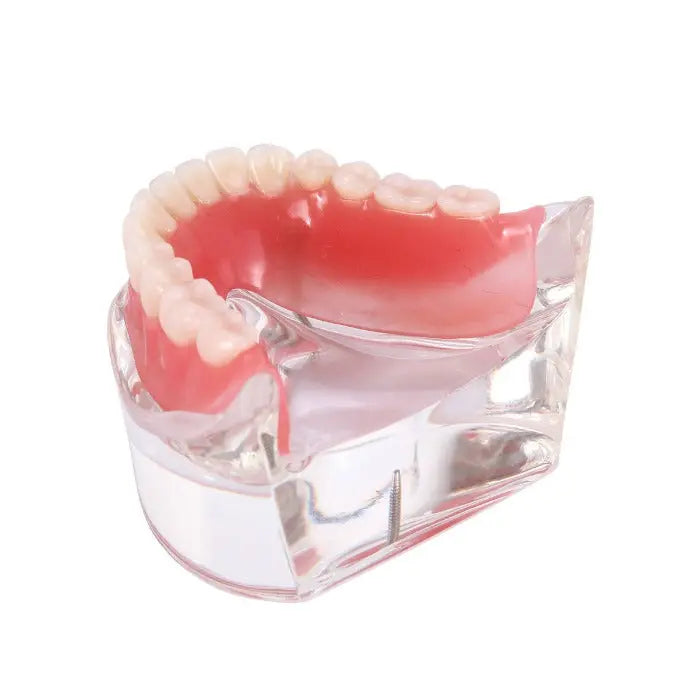 Dental Implant Teeth Model Demo Overdenture Restoration With 2 Implants Lower: Clear acrylic lower jaw model showing removable denture and implant placement, demonstrating overdenture functionality for dental education and patient explanation purposes