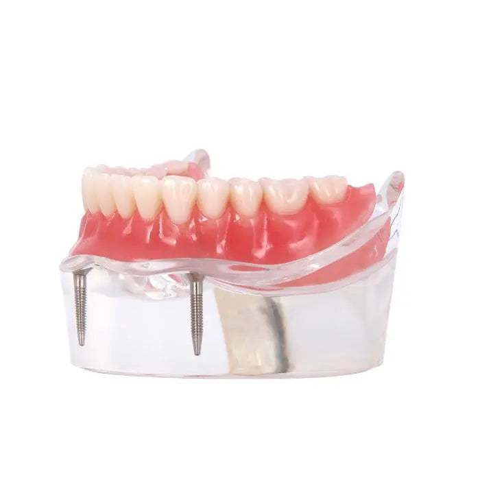 Dental Implant Teeth Model Demo Overdenture Restoration With 2 Implants Lower: Clear acrylic lower jaw model showing realistic teeth, gums, and two visible dental implants, demonstrating overdenture restoration for educational and explanatory purposes in dentistry.