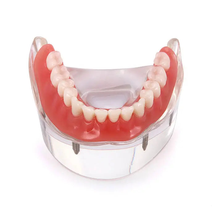 Dental Implant Teeth Model Demo Overdenture Restoration With 4 Implants Lower: Transparent acrylic lower jaw model showcasing removable overdenture with pink gums and white teeth, resting on clear base revealing four implant attachments for educational demonstration purposes.