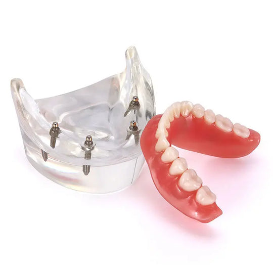 Dental Implant Teeth Model Demo Overdenture Restoration With 4 Implants Lower: Clear acrylic lower jaw model with 4 visible implants and removable red denture, demonstrating overdenture functionality for dental education and patient explanation