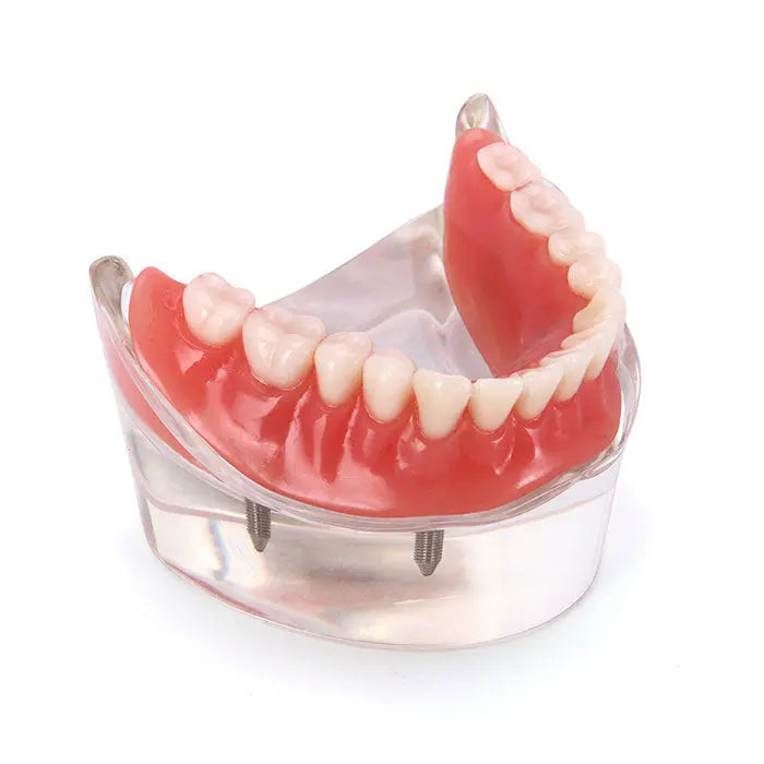 Dental Implant Teeth Model Demo Overdenture Restoration With 4 Implants Lower: Clear acrylic lower jaw model with red gums and white teeth, showing removable overdenture supported by four visible implants in transparent base, demonstrating dental restoration technique.