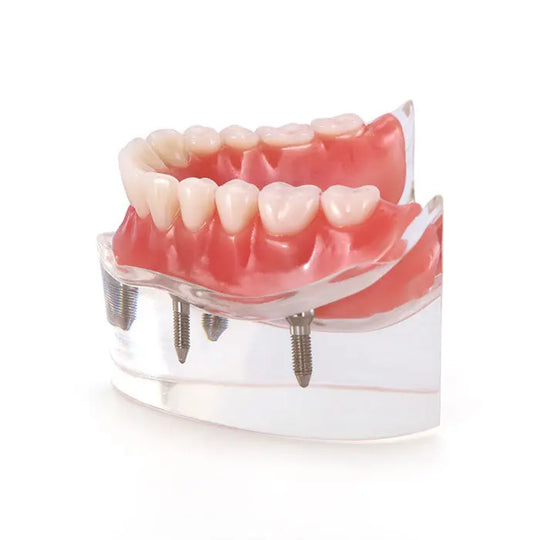 Dental Implant Teeth Model Demo Overdenture Restoration With 4 Implants Lower: Clear lower jaw model showing removable overdenture with 4 implants, demonstrating dental restoration technique for patient education and professional training.