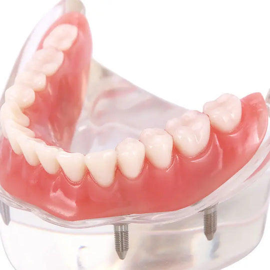 Dental Implant Teeth Model Demo Overdenture Restoration With 4 Implants Lower: Clear acrylic lower jaw model showing removable denture supported by four implants, demonstrating overdenture functionality for dental education and patient explanation purposes.