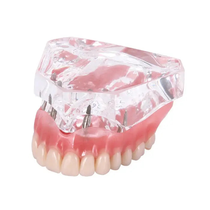 Dental Implant Teeth Model Demo Overdenture Restoration With Implants Upper showing clear acrylic upper jaw with 4 visible implants and removable denture, demonstrating overdenture function for educational purposes