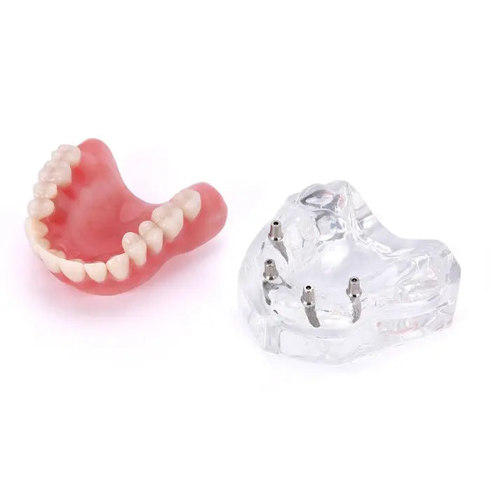 Dental Implant Teeth Model Demo Overdenture Restoration With Implants Upper: Clear acrylic upper jaw model with 4 implants and removable pink denture, showcasing overdenture functioning for dental education and patient explanation