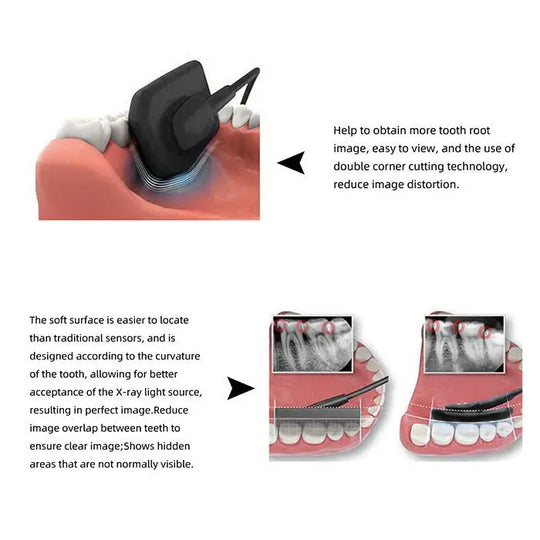 Dental X-Ray Digital RVG Sensor XVS2121 Size 1.0 with Software features and benefits illustrated. Top image shows sensor placement in tooth, bottom images demonstrate clear X-ray results with reduced distortion and overlap, revealing hidden dental areas.