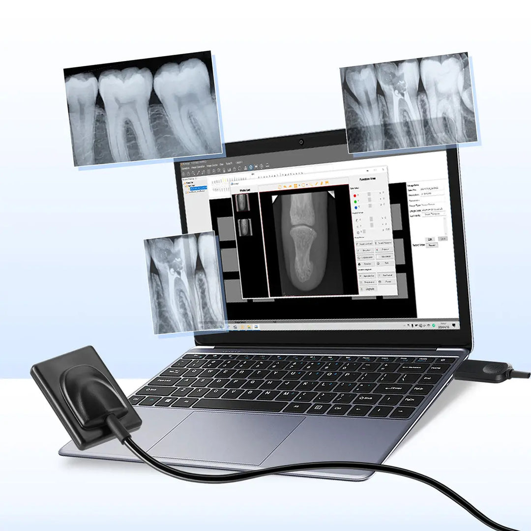 Dental Sensor X-Ray Digital Sensor Intraoral Digital System displaying high-resolution dental x-ray images on laptop screen with connected sensor, showcasing clear tooth details and root canals for efficient diagnosis and treatment planning.