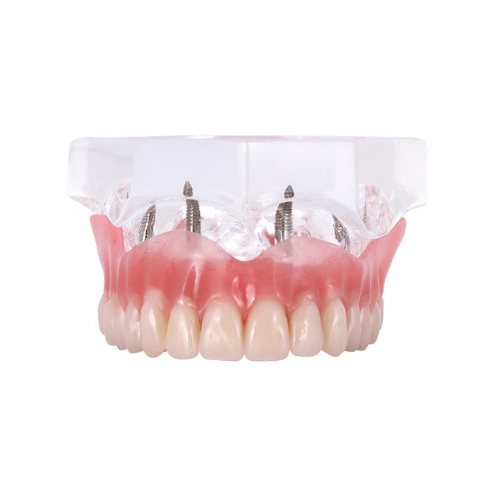 Dental Implant Teeth Model Demo Overdenture Restoration With Implants Upper