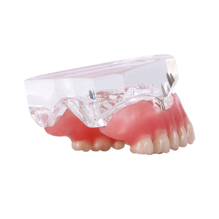 Dental Implant Teeth Model Demo Overdenture Restoration With Implants Upper