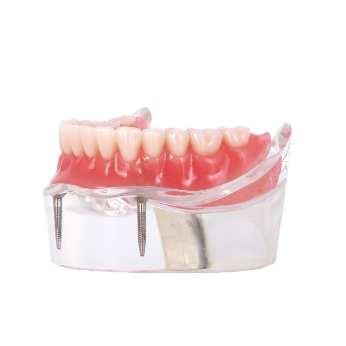 Dental Implant Teeth Model Demo Overdenture Restoration With 2 Implants Lower