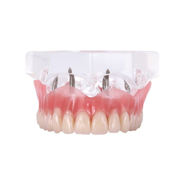 [1549400101] Dental Implant Teeth Model Demo Overdenture Restoration With Implants Upper