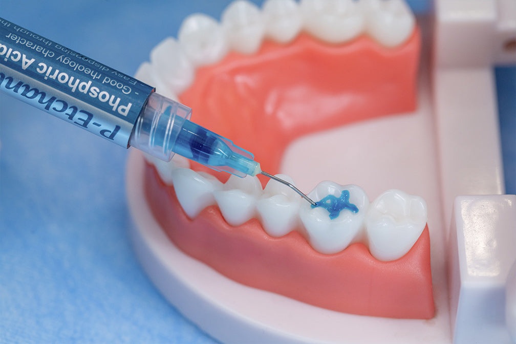 [p-etchant-phosphoric-acid-etching-gel] P-Etchant Phosphoric Acid Etching Gel