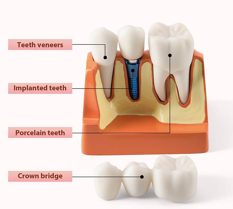 [132002060] Dental 4 Times Implant Teeth Model Analysis Crown Bridge Demonstration Removable (1 Pc)