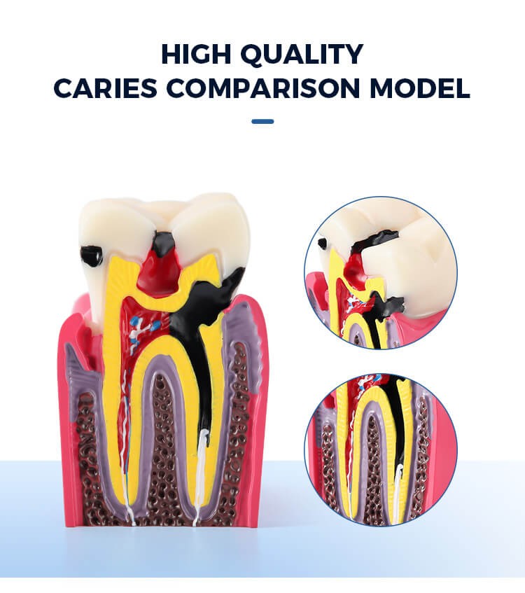 [132002061] Dental Caries Tooth Model 6 Times Decay Teeth Comparative Study Model (1 Pc)